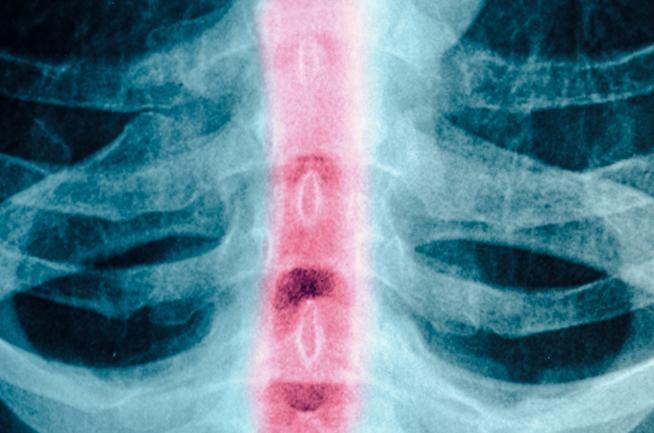 Continuous Monitoring of Spinal Cord Pressure Possible after Spinal Cord Injury